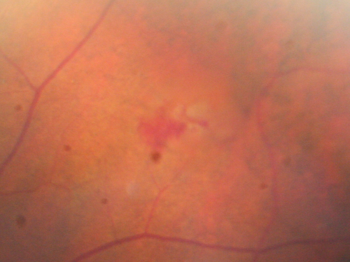 Retinal Tear Before Laser
65-year-old woman new onset floaters for 1 week.  She initially saw flashing lights and then the flashing lights subsided and then she had the floaters VISUAL ACUITY:  OD 20/25,  OS 20/50
