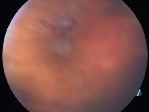 Retinal Flap Tear - Horseshoe - Cystic Retinal Tuft on Flap
73-year-old woman who noticed two days ago she was bending over and had a sudden â€œribbonâ€ in her 
vision which looked to her like blood.  VISUAL ACUITY:  Vision OD is 20/25, OS is 20/20.
