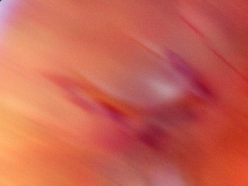 Retinal Flap Tear - Horseshoe - Cystic Retinal Tuft on Flap
73-year-old woman who noticed two days ago she was bending over and had a sudden â€œribbonâ€ in her 
vision which looked to her like blood.  VISUAL ACUITY:  Vision OD is 20/25, OS is 20/20.
