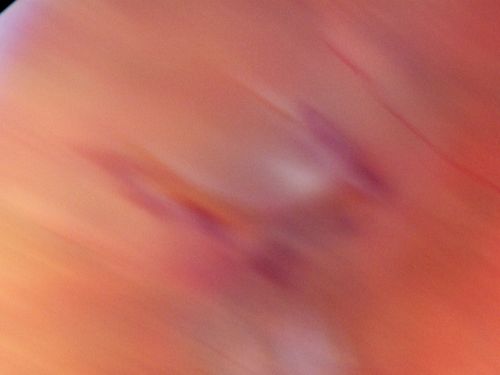 Retinal Flap Tear - Horseshoe - Cystic Retinal Tuft on Flap
73-year-old woman who noticed two days ago she was bending over and had a sudden â€œribbonâ€ in her 
vision which looked to her like blood.  VISUAL ACUITY:  Vision OD is 20/25, OS is 20/20.
