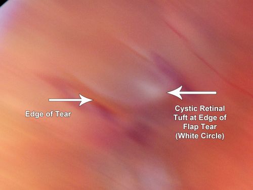 Retinal Flap Tear - Horseshoe - Cystic Retinal Tuft on Flap
73-year-old woman who noticed two days ago she was bending over and had a sudden â€œribbonâ€ in her 
vision which looked to her like blood.  VISUAL ACUITY:  Vision OD is 20/25, OS is 20/20.
