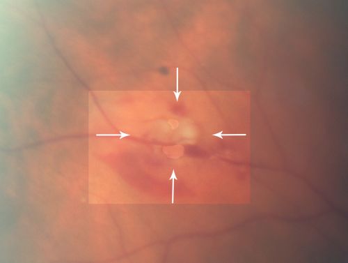 Retinal Tear with Vitreous Hemorrhage before and after Laser Photocoagulation
61-year-old man has noticed increased floaters in the right eye for about the last week.  Vision OD is 20/160 There is 3+ vitreous hemorrhage with a retinal tear, about 2-disc diameters posterior to the equator at 10:00 oâ€™clock over a retinal vessel.

