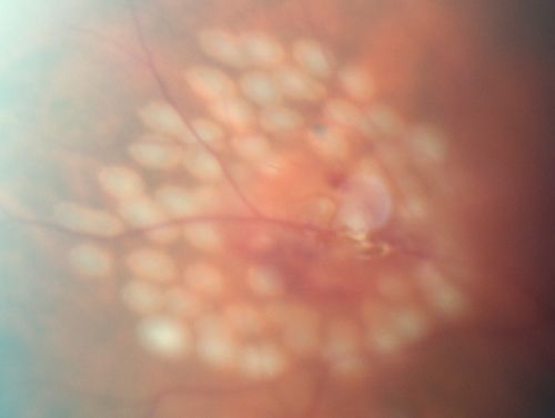 Retinal Tear with Vitreous Hemorrhage before and after Laser Photocoagulation
61-year-old man has noticed increased floaters in the right eye for about the last week.  Vision OD is 20/160 There is 3+ vitreous hemorrhage with a retinal tear, about 2-disc diameters posterior to the equator at 10:00 oâ€™clock over a retinal vessel.

