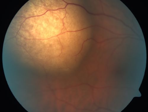 Choroidal Metastases - Both Eyes - Exudative Retinal Detachment
58-year-old man smoke a pack of cigarettes a day.  He has had some ribcage pain for about the last two weeks.  He also had a sinus infection for about two weeks, and he has also had hazy vision on the superior visual field in the left eye for about the last two weeks. vision is 20/25 in both eyes
