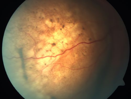 Choroidal Metastases - Both Eyes - Exudative Retinal Detachment
58-year-old man smoke a pack of cigarettes a day.  He has had some ribcage pain for about the last two weeks.  He also had a sinus infection for about two weeks, and he has also had hazy vision on the superior visual field in the left eye for about the last two weeks. vision is 20/25 in both eyes

