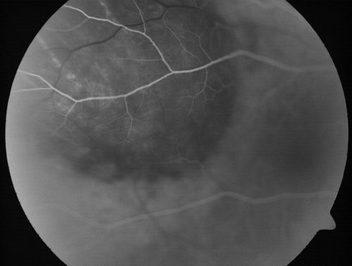 Choroidal Metastases - Both Eyes - Exudative Retinal Detachment
58-year-old man smoke a pack of cigarettes a day.  He has had some ribcage pain for about the last two weeks.  He also had a sinus infection for about two weeks, and he has also had hazy vision on the superior visual field in the left eye for about the last two weeks. vision is 20/25 in both eyes
