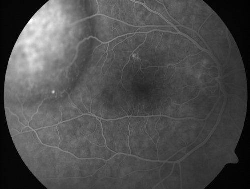 Choroidal Metastases - Both Eyes - Exudative Retinal Detachment
58-year-old man smoke a pack of cigarettes a day.  He has had some ribcage pain for about the last two weeks.  He also had a sinus infection for about two weeks, and he has also had hazy vision on the superior visual field in the left eye for about the last two weeks. vision is 20/25 in both eyes
