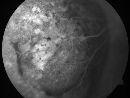 Choroidal Metastases - Both Eyes - Exudative Retinal Detachment
58-year-old man smoke a pack of cigarettes a day.  He has had some ribcage pain for about the last two weeks.  He also had a sinus infection for about two weeks, and he has also had hazy vision on the superior visual field in the left eye for about the last two weeks. vision is 20/25 in both eyes
