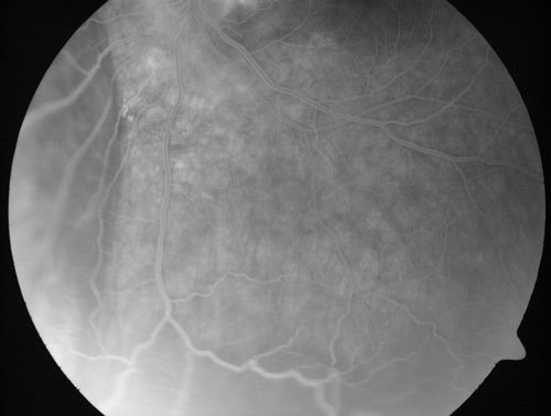 Choroidal Metastases - Both Eyes - Exudative Retinal Detachment
58-year-old man smoke a pack of cigarettes a day.  He has had some ribcage pain for about the last two weeks.  He also had a sinus infection for about two weeks, and he has also had hazy vision on the superior visual field in the left eye for about the last two weeks. vision is 20/25 in both eyes
