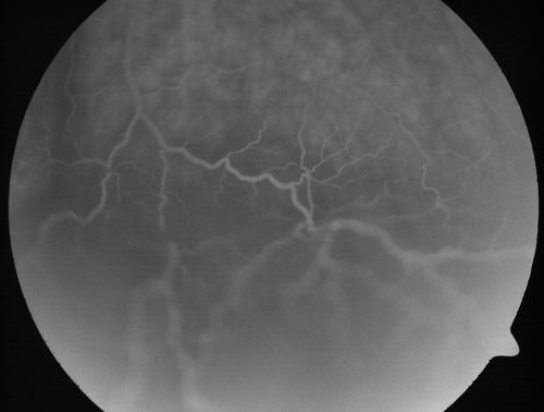 Choroidal Metastases - Both Eyes - Exudative Retinal Detachment
58-year-old man smoke a pack of cigarettes a day.  He has had some ribcage pain for about the last two weeks.  He also had a sinus infection for about two weeks, and he has also had hazy vision on the superior visual field in the left eye for about the last two weeks. vision is 20/25 in both eyes
