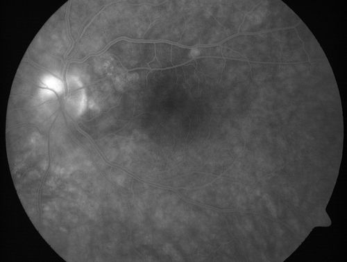Choroidal Metastases - Both Eyes - Exudative Retinal Detachment
58-year-old man smoke a pack of cigarettes a day.  He has had some ribcage pain for about the last two weeks.  He also had a sinus infection for about two weeks, and he has also had hazy vision on the superior visual field in the left eye for about the last two weeks. vision is 20/25 in both eyes
