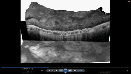 Macular Laser Scars - Patient had Central Retinal Vein Occlusion in her only eye
80-year-old woman left eye had a vascular occlusion, probably about five years ago, subsequent to that she had macular laser. She said since then the vision has been poor. OS 20/160.
