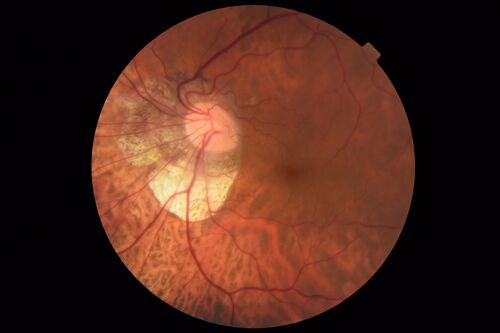 Tilted Disc Syndrome
56 year old female.  Recent motor vehicle accident.  Vision is 20/50 OD, 20/25 OS.
