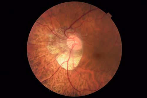 Tilted Disc Syndrome
56 year old female.  Recent motor vehicle accident.  Vision is 20/50 OD, 20/25 OS.
