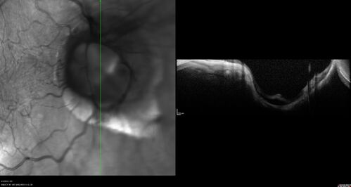 Tilted Disc Syndrome
56 year old female.  Recent motor vehicle accident.  Vision is 20/50 OD, 20/25 OS.
