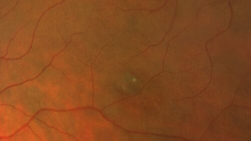 Torpedo Maculopathy - Small Lesion
Asymptomatic 77 year old female
