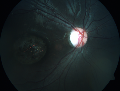 Congenital Toxoplasmosis Right Eye - Macular Scar
6 year old child who immigrated from Brazil and failed school screening .  VA OD 20/200
