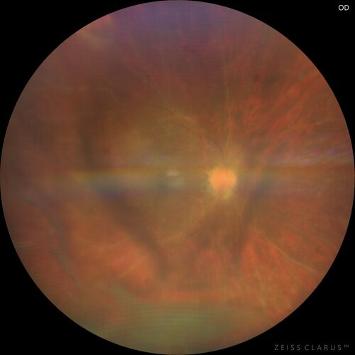 Toxoplasmosis right eye with diffuse retinal vascular whitening PCR confirmed
66 year old man The patient was doing fine until about 2-3 months ago.Â  He woke up with shadows and spots in the right eye.Â  Every blue moon he gets some pain in the right eye.Â  He has been getting treated with eye drops in the right eye.Â  Since this happened the vision is mostly the same.Â  Sometimes he sees better than other times.Â  He has not been treated with oral medications.Â Â 
Medical history: none â€“ Medications: none, ROS negative
VA OD: sc20/63-1 OS: sc20/20 
IOP: TP: OD:15 OS:20Â 
Negative labs: ACE, Lysozyme, RPR, HLA B27, Quant TB Gold, ESR (slight elevation of CRP)
PCR anterior chamber: negative herpes virus (HSV, VZV, CMV)
Positive for toxoplasmosis
