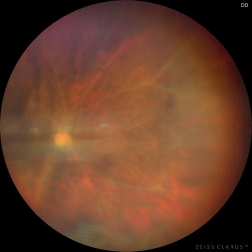 Toxoplasmosis right eye with diffuse retinal vascular whitening PCR confirmed
66 year old man The patient was doing fine until about 2-3 months ago.Â  He woke up with shadows and spots in the right eye.Â  Every blue moon he gets some pain in the right eye.Â  He has been getting treated with eye drops in the right eye.Â  Since this happened the vision is mostly the same.Â  Sometimes he sees better than other times.Â  He has not been treated with oral medications.Â Â 
Medical history: none â€“ Medications: none, ROS negative
VA OD: sc20/63-1 OS: sc20/20 
IOP: TP: OD:15 OS:20Â 
Negative labs: ACE, Lysozyme, RPR, HLA B27, Quant TB Gold, ESR (slight elevation of CRP)
PCR anterior chamber: negative herpes virus (HSV, VZV, CMV)
Positive for toxoplasmosis
