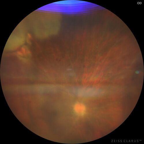 Toxoplasmosis right eye with diffuse retinal vascular whitening PCR confirmed
66 year old man The patient was doing fine until about 2-3 months ago.Â  He woke up with shadows and spots in the right eye.Â  Every blue moon he gets some pain in the right eye.Â  He has been getting treated with eye drops in the right eye.Â  Since this happened the vision is mostly the same.Â  Sometimes he sees better than other times.Â  He has not been treated with oral medications.Â Â 
Medical history: none â€“ Medications: none, ROS negative
VA OD: sc20/63-1 OS: sc20/20 
IOP: TP: OD:15 OS:20Â 
Negative labs: ACE, Lysozyme, RPR, HLA B27, Quant TB Gold, ESR (slight elevation of CRP)
PCR anterior chamber: negative herpes virus (HSV, VZV, CMV)
Positive for toxoplasmosis
