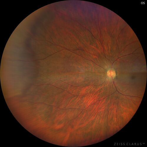 Toxoplasmosis right eye with diffuse retinal vascular whitening PCR confirmed
66 year old man The patient was doing fine until about 2-3 months ago.Â  He woke up with shadows and spots in the right eye.Â  Every blue moon he gets some pain in the right eye.Â  He has been getting treated with eye drops in the right eye.Â  Since this happened the vision is mostly the same.Â  Sometimes he sees better than other times.Â  He has not been treated with oral medications.Â Â 
Medical history: none â€“ Medications: none, ROS negative
VA OD: sc20/63-1 OS: sc20/20 
IOP: TP: OD:15 OS:20Â 
Negative labs: ACE, Lysozyme, RPR, HLA B27, Quant TB Gold, ESR (slight elevation of CRP)
PCR anterior chamber: negative herpes virus (HSV, VZV, CMV)
Positive for toxoplasmosis
