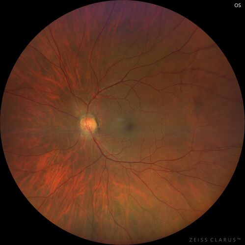 Toxoplasmosis right eye with diffuse retinal vascular whitening PCR confirmed
66 year old man The patient was doing fine until about 2-3 months ago.Â  He woke up with shadows and spots in the right eye.Â  Every blue moon he gets some pain in the right eye.Â  He has been getting treated with eye drops in the right eye.Â  Since this happened the vision is mostly the same.Â  Sometimes he sees better than other times.Â  He has not been treated with oral medications.Â Â 
Medical history: none â€“ Medications: none, ROS negative
VA OD: sc20/63-1 OS: sc20/20 
IOP: TP: OD:15 OS:20Â 
Negative labs: ACE, Lysozyme, RPR, HLA B27, Quant TB Gold, ESR (slight elevation of CRP)
PCR anterior chamber: negative herpes virus (HSV, VZV, CMV)
Positive for toxoplasmosis
