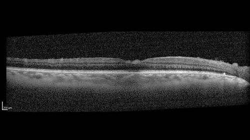 Toxoplasmosis right eye with diffuse retinal vascular whitening PCR confirmed
66 year old man The patient was doing fine until about 2-3 months ago.Â  He woke up with shadows and spots in the right eye.Â  Every blue moon he gets some pain in the right eye.Â  He has been getting treated with eye drops in the right eye.Â  Since this happened the vision is mostly the same.Â  Sometimes he sees better than other times.Â  He has not been treated with oral medications.Â Â 
Medical history: none â€“ Medications: none, ROS negative
VA OD: sc20/63-1 OS: sc20/20 
IOP: TP: OD:15 OS:20Â 
Negative labs: ACE, Lysozyme, RPR, HLA B27, Quant TB Gold, ESR (slight elevation of CRP)
PCR anterior chamber: negative herpes virus (HSV, VZV, CMV)
Positive for toxoplasmosis
