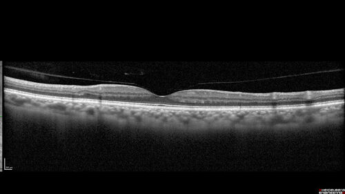 Toxoplasmosis right eye with diffuse retinal vascular whitening PCR confirmed
66 year old man The patient was doing fine until about 2-3 months ago.Â  He woke up with shadows and spots in the right eye.Â  Every blue moon he gets some pain in the right eye.Â  He has been getting treated with eye drops in the right eye.Â  Since this happened the vision is mostly the same.Â  Sometimes he sees better than other times.Â  He has not been treated with oral medications.Â Â 
Medical history: none â€“ Medications: none, ROS negative
VA OD: sc20/63-1 OS: sc20/20 
IOP: TP: OD:15 OS:20Â 
Negative labs: ACE, Lysozyme, RPR, HLA B27, Quant TB Gold, ESR (slight elevation of CRP)
PCR anterior chamber: negative herpes virus (HSV, VZV, CMV)
Positive for toxoplasmosis

