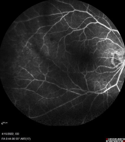 Toxoplasmosis right eye with diffuse retinal vascular whitening PCR confirmed
66 year old man The patient was doing fine until about 2-3 months ago.Â  He woke up with shadows and spots in the right eye.Â  Every blue moon he gets some pain in the right eye.Â  He has been getting treated with eye drops in the right eye.Â  Since this happened the vision is mostly the same.Â  Sometimes he sees better than other times.Â  He has not been treated with oral medications.Â Â 
Medical history: none â€“ Medications: none, ROS negative
VA OD: sc20/63-1 OS: sc20/20 
IOP: TP: OD:15 OS:20Â 
Negative labs: ACE, Lysozyme, RPR, HLA B27, Quant TB Gold, ESR (slight elevation of CRP)
PCR anterior chamber: negative herpes virus (HSV, VZV, CMV)
Positive for toxoplasmosis
