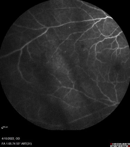 Toxoplasmosis right eye with diffuse retinal vascular whitening PCR confirmed
66 year old man The patient was doing fine until about 2-3 months ago.Â  He woke up with shadows and spots in the right eye.Â  Every blue moon he gets some pain in the right eye.Â  He has been getting treated with eye drops in the right eye.Â  Since this happened the vision is mostly the same.Â  Sometimes he sees better than other times.Â  He has not been treated with oral medications.Â Â 
Medical history: none â€“ Medications: none, ROS negative
VA OD: sc20/63-1 OS: sc20/20 
IOP: TP: OD:15 OS:20Â 
Negative labs: ACE, Lysozyme, RPR, HLA B27, Quant TB Gold, ESR (slight elevation of CRP)
PCR anterior chamber: negative herpes virus (HSV, VZV, CMV)
Positive for toxoplasmosis
