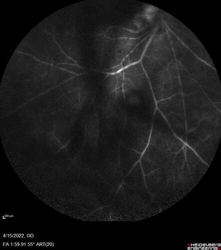 Toxoplasmosis right eye with diffuse retinal vascular whitening PCR confirmed
66 year old man The patient was doing fine until about 2-3 months ago.Â  He woke up with shadows and spots in the right eye.Â  Every blue moon he gets some pain in the right eye.Â  He has been getting treated with eye drops in the right eye.Â  Since this happened the vision is mostly the same.Â  Sometimes he sees better than other times.Â  He has not been treated with oral medications.Â Â 
Medical history: none â€“ Medications: none, ROS negative
VA OD: sc20/63-1 OS: sc20/20 
IOP: TP: OD:15 OS:20Â 
Negative labs: ACE, Lysozyme, RPR, HLA B27, Quant TB Gold, ESR (slight elevation of CRP)
PCR anterior chamber: negative herpes virus (HSV, VZV, CMV)
Positive for toxoplasmosis
