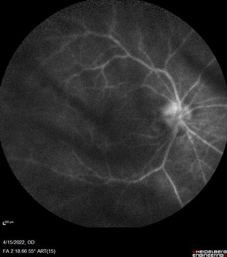 Toxoplasmosis right eye with diffuse retinal vascular whitening PCR confirmed
66 year old man The patient was doing fine until about 2-3 months ago.Â  He woke up with shadows and spots in the right eye.Â  Every blue moon he gets some pain in the right eye.Â  He has been getting treated with eye drops in the right eye.Â  Since this happened the vision is mostly the same.Â  Sometimes he sees better than other times.Â  He has not been treated with oral medications.Â Â 
Medical history: none â€“ Medications: none, ROS negative
VA OD: sc20/63-1 OS: sc20/20 
IOP: TP: OD:15 OS:20Â 
Negative labs: ACE, Lysozyme, RPR, HLA B27, Quant TB Gold, ESR (slight elevation of CRP)
PCR anterior chamber: negative herpes virus (HSV, VZV, CMV)
Positive for toxoplasmosis
