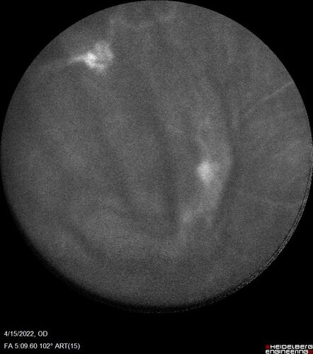 Toxoplasmosis right eye with diffuse retinal vascular whitening PCR confirmed
66 year old man The patient was doing fine until about 2-3 months ago.Â  He woke up with shadows and spots in the right eye.Â  Every blue moon he gets some pain in the right eye.Â  He has been getting treated with eye drops in the right eye.Â  Since this happened the vision is mostly the same.Â  Sometimes he sees better than other times.Â  He has not been treated with oral medications.Â Â 
Medical history: none â€“ Medications: none, ROS negative
VA OD: sc20/63-1 OS: sc20/20 
IOP: TP: OD:15 OS:20Â 
Negative labs: ACE, Lysozyme, RPR, HLA B27, Quant TB Gold, ESR (slight elevation of CRP)
PCR anterior chamber: negative herpes virus (HSV, VZV, CMV)
Positive for toxoplasmosis
