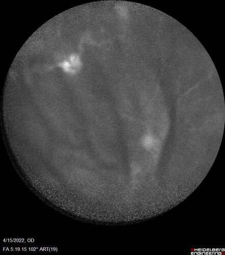 Toxoplasmosis right eye with diffuse retinal vascular whitening PCR confirmed
66 year old man The patient was doing fine until about 2-3 months ago.Â  He woke up with shadows and spots in the right eye.Â  Every blue moon he gets some pain in the right eye.Â  He has been getting treated with eye drops in the right eye.Â  Since this happened the vision is mostly the same.Â  Sometimes he sees better than other times.Â  He has not been treated with oral medications.Â Â 
Medical history: none â€“ Medications: none, ROS negative
VA OD: sc20/63-1 OS: sc20/20 
IOP: TP: OD:15 OS:20Â 
Negative labs: ACE, Lysozyme, RPR, HLA B27, Quant TB Gold, ESR (slight elevation of CRP)
PCR anterior chamber: negative herpes virus (HSV, VZV, CMV)
Positive for toxoplasmosis
