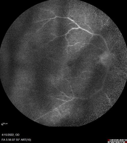 Toxoplasmosis right eye with diffuse retinal vascular whitening PCR confirmed
66 year old man The patient was doing fine until about 2-3 months ago.Â  He woke up with shadows and spots in the right eye.Â  Every blue moon he gets some pain in the right eye.Â  He has been getting treated with eye drops in the right eye.Â  Since this happened the vision is mostly the same.Â  Sometimes he sees better than other times.Â  He has not been treated with oral medications.Â Â 
Medical history: none â€“ Medications: none, ROS negative
VA OD: sc20/63-1 OS: sc20/20 
IOP: TP: OD:15 OS:20Â 
Negative labs: ACE, Lysozyme, RPR, HLA B27, Quant TB Gold, ESR (slight elevation of CRP)
PCR anterior chamber: negative herpes virus (HSV, VZV, CMV)
Positive for toxoplasmosis
