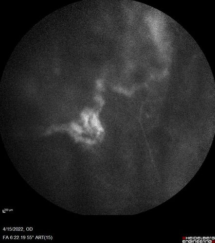 Toxoplasmosis right eye with diffuse retinal vascular whitening PCR confirmed
66 year old man The patient was doing fine until about 2-3 months ago.Â  He woke up with shadows and spots in the right eye.Â  Every blue moon he gets some pain in the right eye.Â  He has been getting treated with eye drops in the right eye.Â  Since this happened the vision is mostly the same.Â  Sometimes he sees better than other times.Â  He has not been treated with oral medications.Â Â 
Medical history: none â€“ Medications: none, ROS negative
VA OD: sc20/63-1 OS: sc20/20 
IOP: TP: OD:15 OS:20Â 
Negative labs: ACE, Lysozyme, RPR, HLA B27, Quant TB Gold, ESR (slight elevation of CRP)
PCR anterior chamber: negative herpes virus (HSV, VZV, CMV)
Positive for toxoplasmosis
