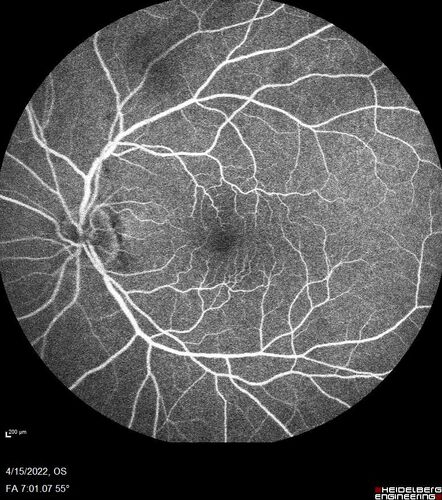 Toxoplasmosis right eye with diffuse retinal vascular whitening PCR confirmed
66 year old man The patient was doing fine until about 2-3 months ago.Â  He woke up with shadows and spots in the right eye.Â  Every blue moon he gets some pain in the right eye.Â  He has been getting treated with eye drops in the right eye.Â  Since this happened the vision is mostly the same.Â  Sometimes he sees better than other times.Â  He has not been treated with oral medications.Â Â 
Medical history: none â€“ Medications: none, ROS negative
VA OD: sc20/63-1 OS: sc20/20 
IOP: TP: OD:15 OS:20Â 
Negative labs: ACE, Lysozyme, RPR, HLA B27, Quant TB Gold, ESR (slight elevation of CRP)
PCR anterior chamber: negative herpes virus (HSV, VZV, CMV)
Positive for toxoplasmosis
