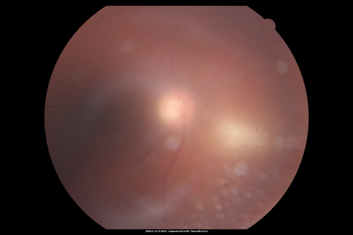 Toxoplasmosis Retinitis - Vitritis and Anerior Uveitis

