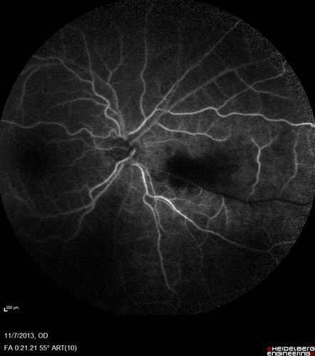 Toxoplasmosis Retinitis - Vitritis and Anerior Uveitis
