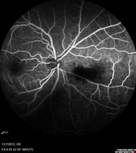 Toxoplasmosis Retinitis - Vitritis and Anerior Uveitis
