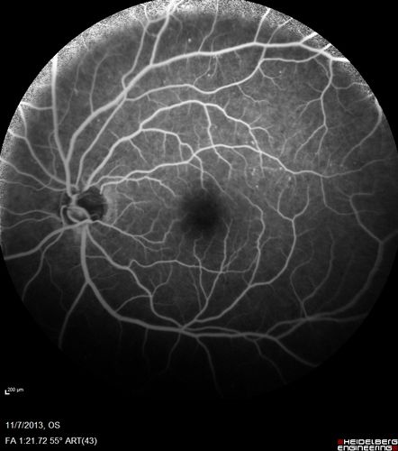 Toxoplasmosis Retinitis - Vitritis and Anerior Uveitis
