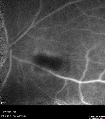 Toxoplasmosis Retinitis - Vitritis and Anerior Uveitis
