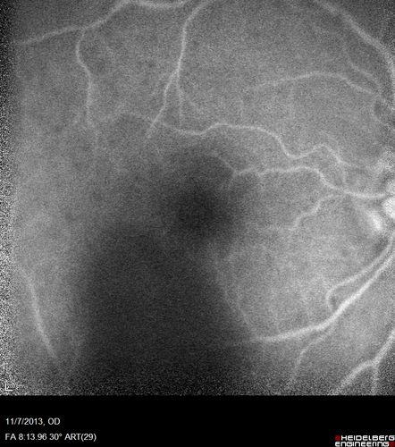Toxoplasmosis Retinitis - Vitritis and Anerior Uveitis
