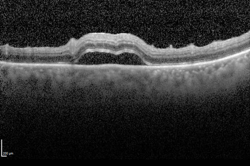 Toxoplasmosis Retinitis - Vitritis and Anerior Uveitis
Serous Retinal Detachment Associated with Lesion
