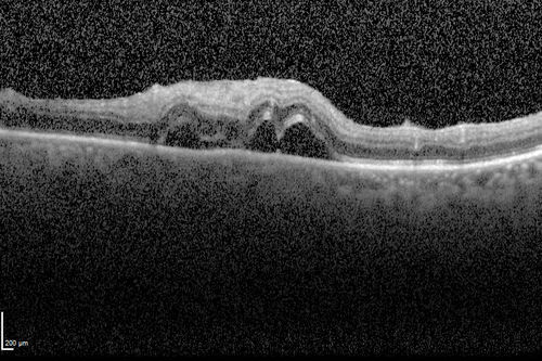 Toxoplasmosis Retinitis - Vitritis and Anerior Uveitis
Serous Retinal Detachment Associated with Lesion
