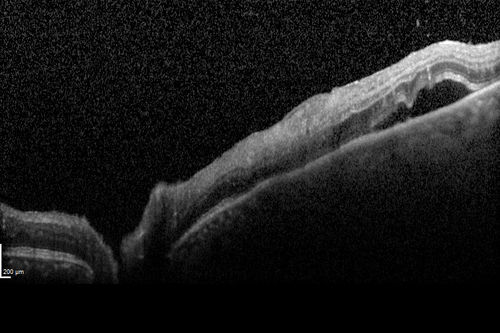 Toxoplasmosis Retinitis - Vitritis and Anerior Uveitis
Serous Retinal Detachment Associated with Lesion
