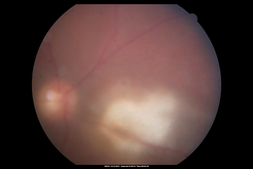 Toxoplasmosis Retinitis - Vitritis and Anerior Uveitis
2 weeks after starting treatment - lesion is involuting
