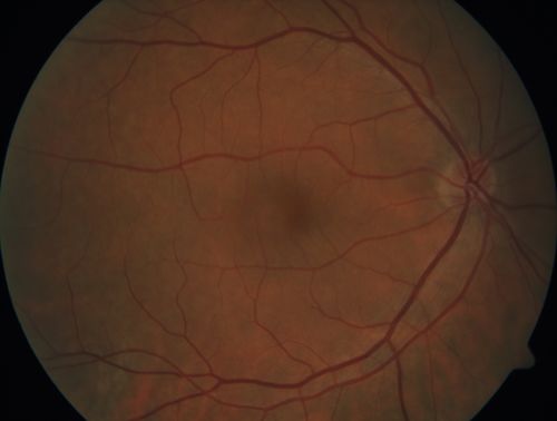 Acquired Toxoplasmosis Retinitis Para Foveal - Following Venison Consumption
56 year old man who became very sick after eating venison at the end of December 2019.  Presented 6 weeks later with a scotoma.  Initial photos show presentation with 20/63 vision.  Vision dropped to 5/200.  All tests (including PCR of anterior chamber tap) were negative except serum toxoplasmosis IgG and IgM.  Vision improved to 20/32 but the scotoma remained on oral trimetheprim/sulfa
