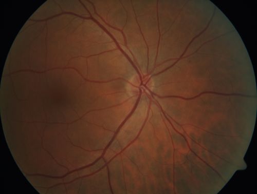 Acquired Toxoplasmosis Retinitis Para Foveal - Following Venison Consumption
56 year old man who became very sick after eating venison at the end of December 2019.  Presented 6 weeks later with a scotoma.  Initial photos show presentation with 20/63 vision.  Vision dropped to 5/200.  All tests (including PCR of anterior chamber tap) were negative except serum toxoplasmosis IgG and IgM.  Vision improved to 20/32 but the scotoma remained on oral trimetheprim/sulfa
