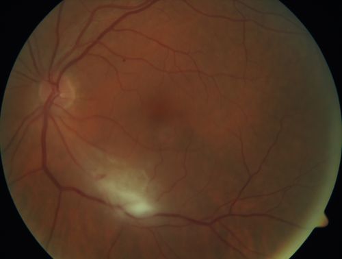 Acquired Toxoplasmosis Retinitis Para Foveal - Following Venison Consumption
56 year old man who became very sick after eating venison at the end of December 2019.  Presented 6 weeks later with a scotoma.  Initial photos show presentation with 20/63 vision.  Vision dropped to 5/200.  All tests (including PCR of anterior chamber tap) were negative except serum toxoplasmosis IgG and IgM.  Vision improved to 20/32 but the scotoma remained on oral trimetheprim/sulfa
